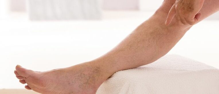 Kŕčové žily na nohách